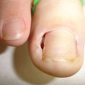 ingrown toenails - treatment by Up and Running Podiatry Melbourne