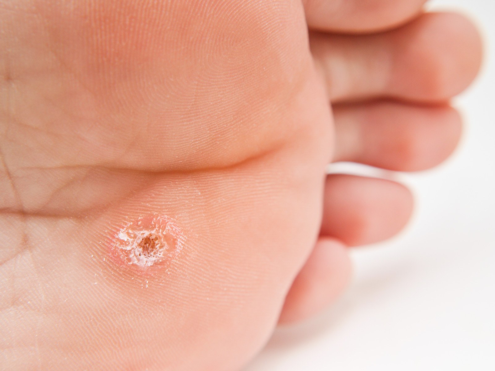 plantar warts - treatment by Up and Running podiatry melbourne